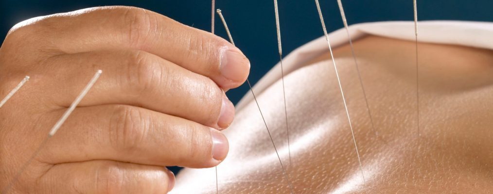 What is Dry Needling and What Does it Do?